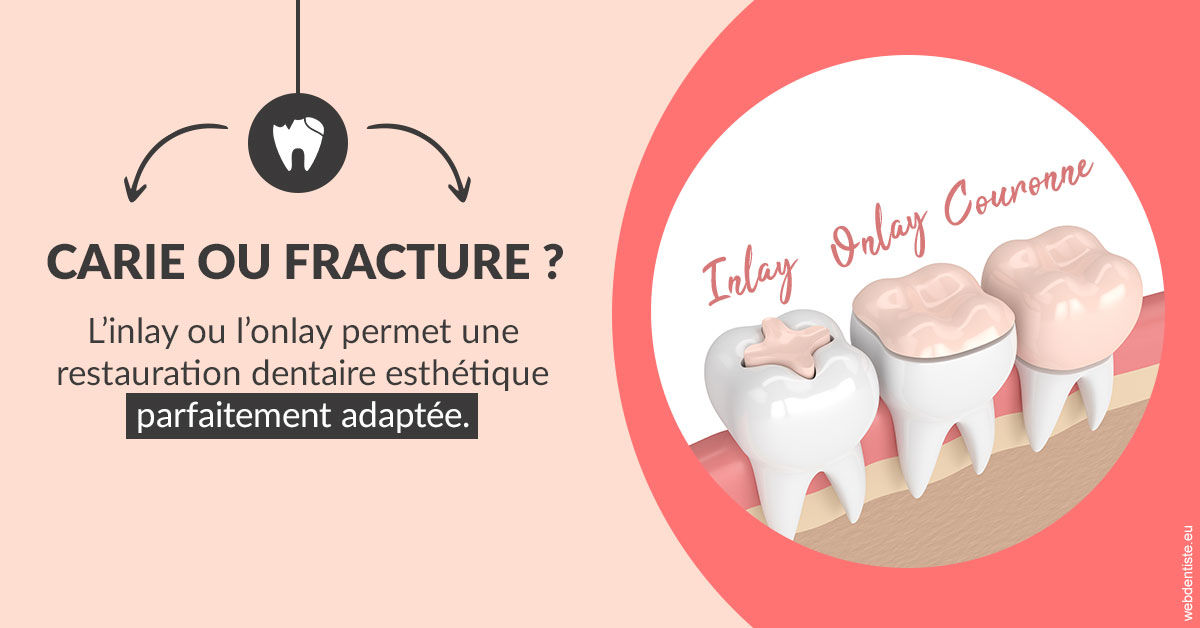 https://dr-roquette-guillaume.chirurgiens-dentistes.fr/T2 2023 - Carie ou fracture 2