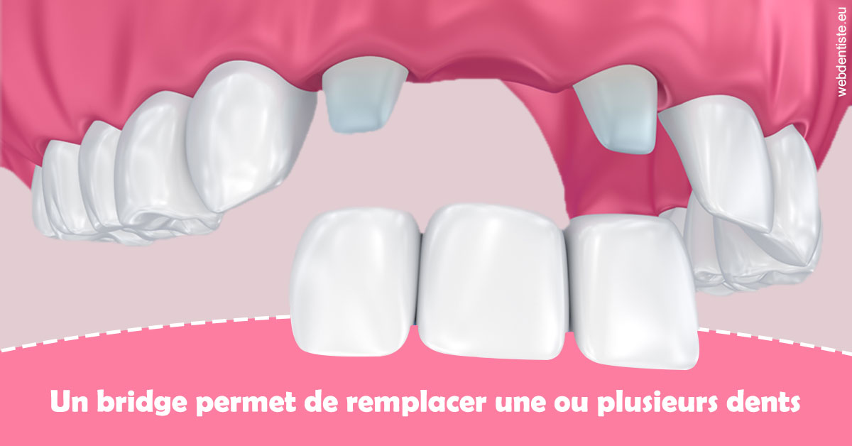 https://dr-roquette-guillaume.chirurgiens-dentistes.fr/Bridge remplacer dents 2
