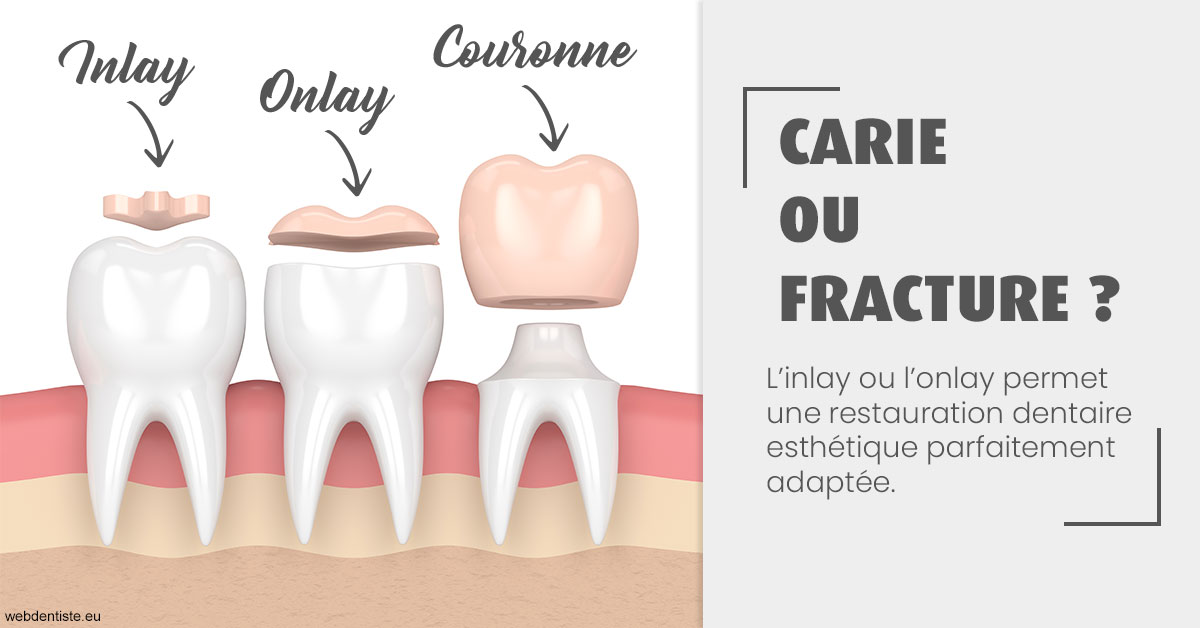 https://dr-roquette-guillaume.chirurgiens-dentistes.fr/T2 2023 - Carie ou fracture 1