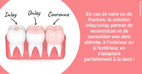 https://dr-roquette-guillaume.chirurgiens-dentistes.fr/L'INLAY ou l'ONLAY 2