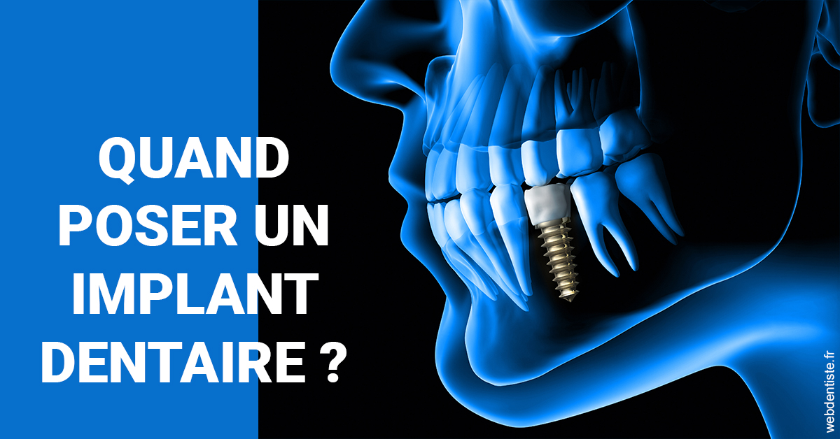 https://dr-roquette-guillaume.chirurgiens-dentistes.fr/Les implants 1