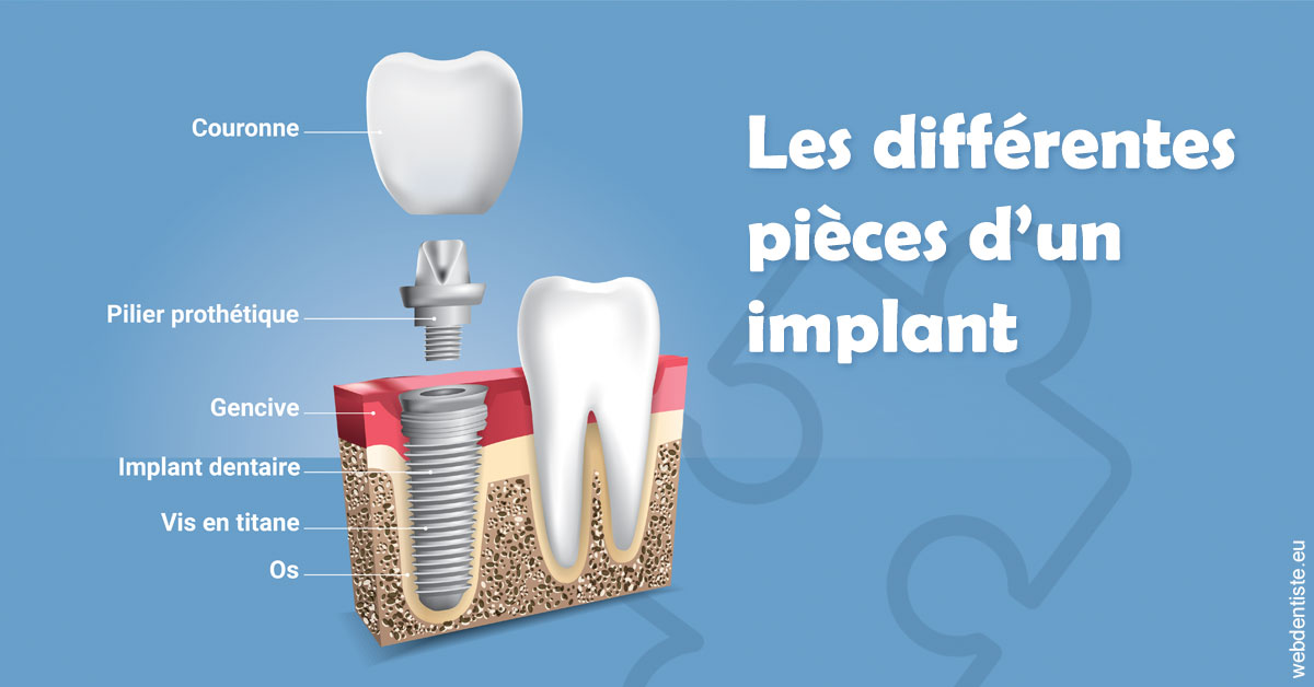 https://dr-roquette-guillaume.chirurgiens-dentistes.fr/Les différentes pièces d’un implant 1